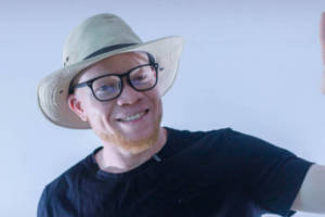 How albinism affects the eyes