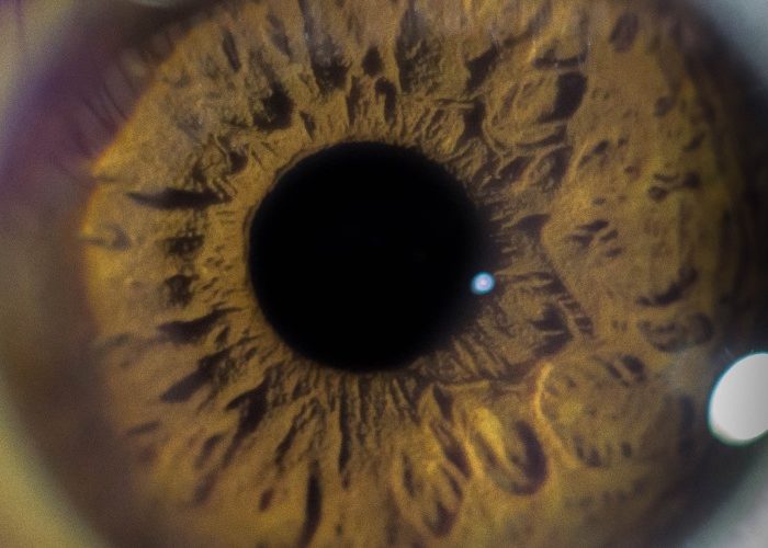 Common Eye Disorders